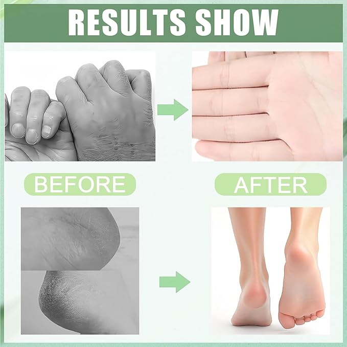 Turmeric & 60% Urea Foot Cream Set, Hydrating & Softening Hand and Foot Cream Balm Stick, Hand and Foot Cracked Heel Stick Moisturizer, Urea Cream 60 Percent for Feet Maximum Strength, 1.41 Oz Each