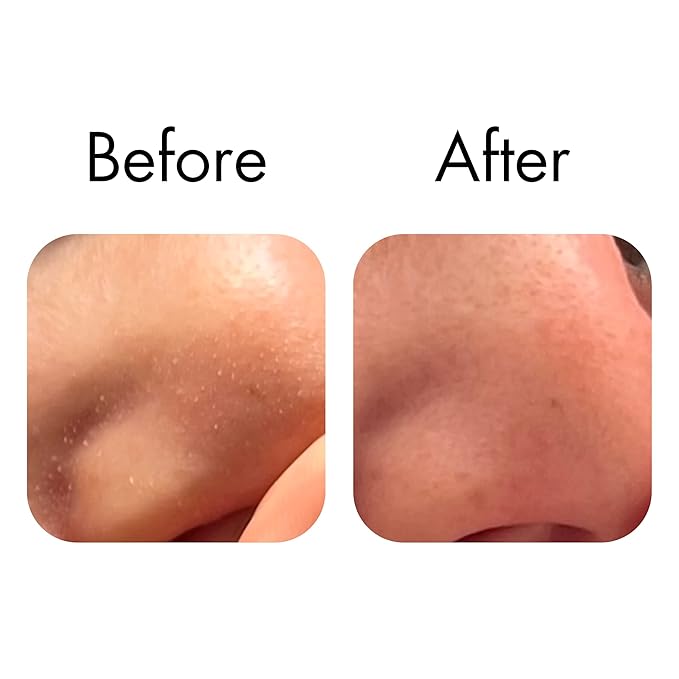 FAZIT Zit Zapper Nose Pore Patch -20-Pc Pimple Patch Set - Hydrocolloid Acne Best Nose Blackhead Remover Patches -Overnight Nose Pore Strips Blackhead Remover for Face Patches -Blemish &Spot Treatment