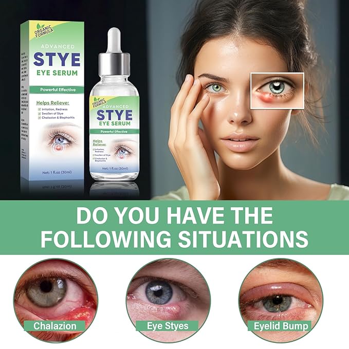 Stye Eye Treatment, Effective Stye Eye Drops Serum for Styes Chalazion and Blepharitis, Fast Chalazion Remover for Restore Healthier Ey-e Skin