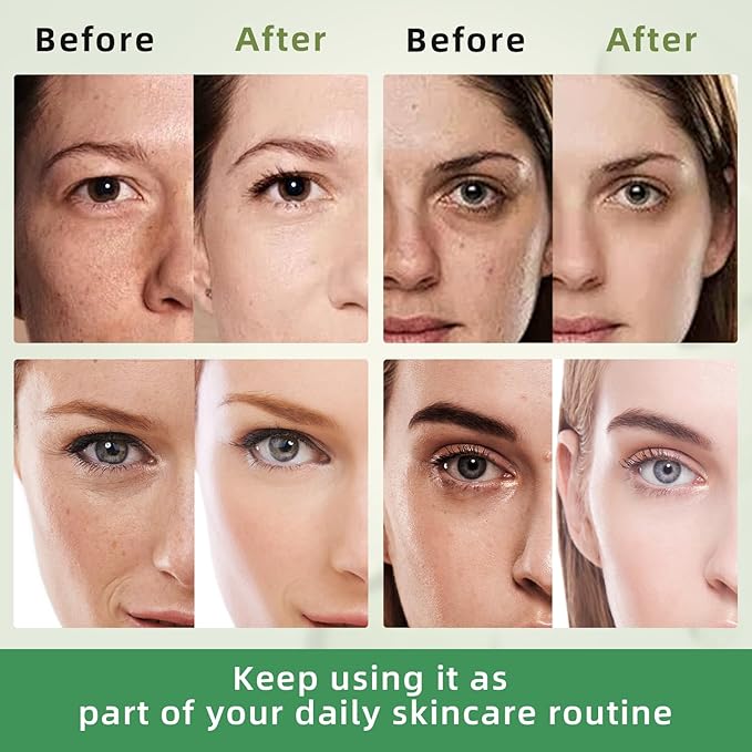 Dark Spot Remover for Face with Roller: Dark Spot Corrector for Face Fading Sun Spot Age Spot Melasma