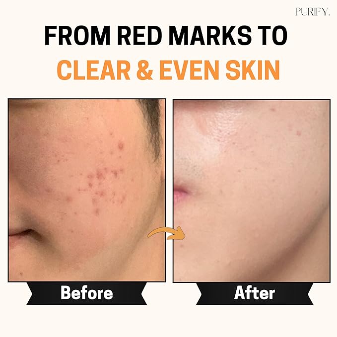 Purify 20% Vitamin C Serum - with Vitamin E & Ferulic Acid - Anti Aging - Brightening Face Serum - Pure Vit C for Dark Spots Correcting, Uneven Skin Tone, Wrinkles, Glow - 1 fl oz.