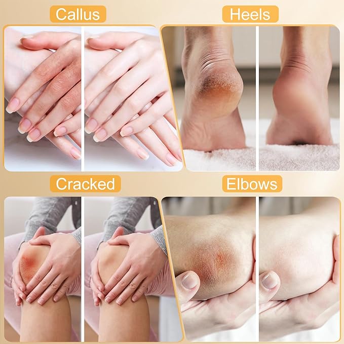 Urea Cream 40%,Urea Cream 42% Plus 2% Salicylic Acid Maximum Strength For Feet,Foot Cream for Dry Cracked Heels Feet Knees Elbows Hand,Travel and Home Foot Care Kit,Foot Heel,Gift Pack