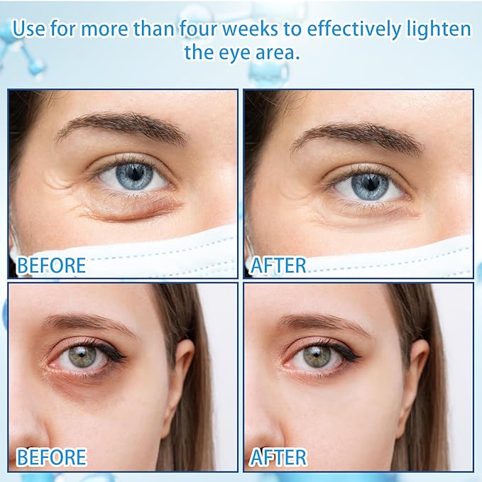 5% Caffeine Eye Serum with 360ยฐ Massage Rollerball Topper,Caffeine Cream for Dark Circles,Wrinkles,Puffiness and Fine Lines,Under Eye Roller Cream Treatment for Women and Men