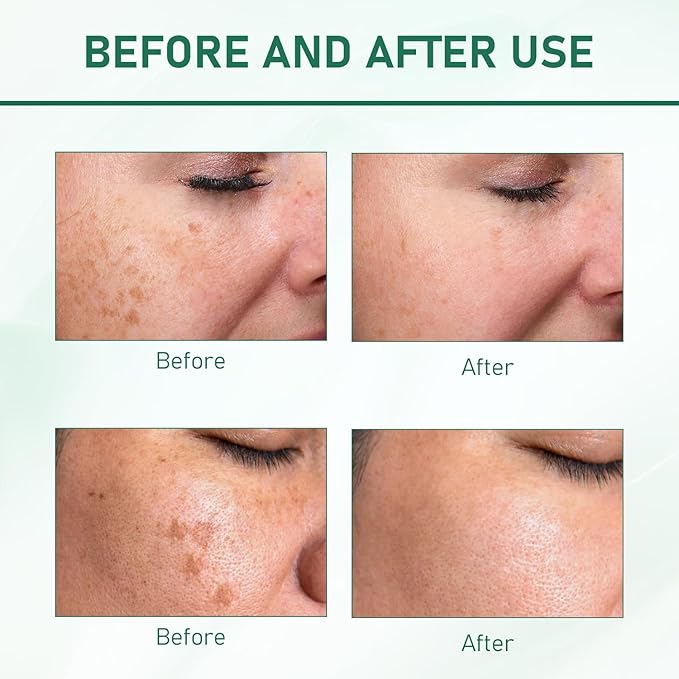 2Pcs Upgraded Anti-ππ«πππ€π₯π Essence Oil, 577 ππ©π¨π Remover Serum, Yuxintang Facial Spray, 577 Spray for Face, Body