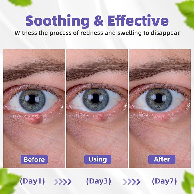 Stye Eye Treatment, Natural Relief Drops Serum for Styes Chalazion and Blepharitis, Fast Chalazion Remover for Restore Healthier Eye Skin (1 Fl Oz (Pack of 1), Original)