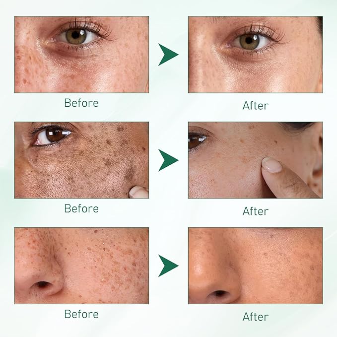 2Pcs Upgraded Anti-ππ«πππ€π₯π Essence Oil, 577 ππ©π¨π Remover Serum, Yuxintang Facial Spray, 577 Spray for Face, Body