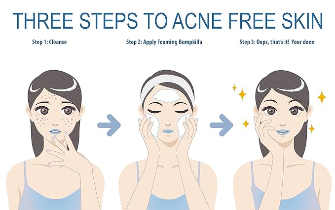 Acne Treatment For Sensitive Skin - 80% of Acne Gone in 4 Weeks. (Refill Bottle)