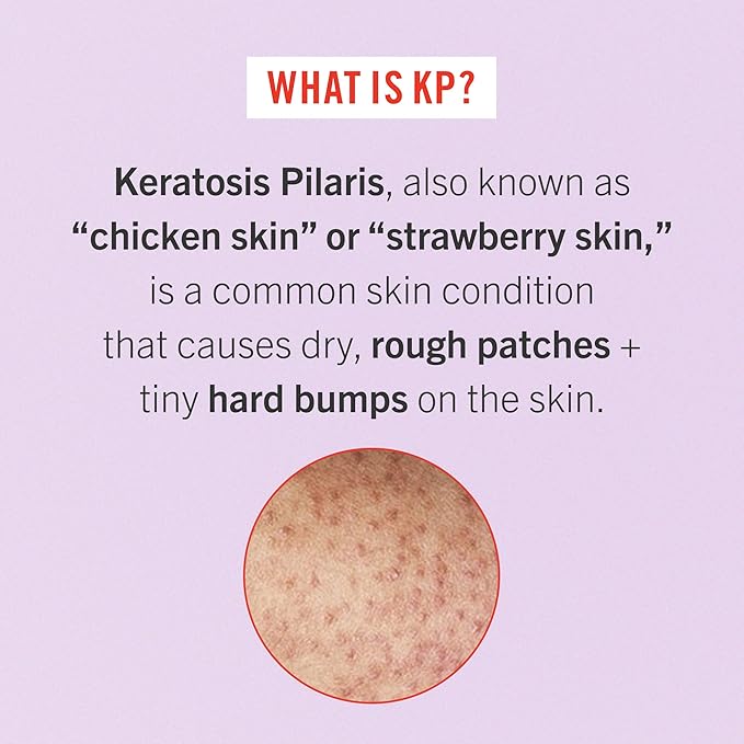 First Aid Beauty - Bye Bye Bumps Kit: KP Bump Eraser Body Scrub, 4 oz, Smoothing Lotion, 1oz, and Ingrown Hair Pads, 28 Pads, Deep Moisture Exfoliating Skin Treatment Set with BHA & AHA, 3ct