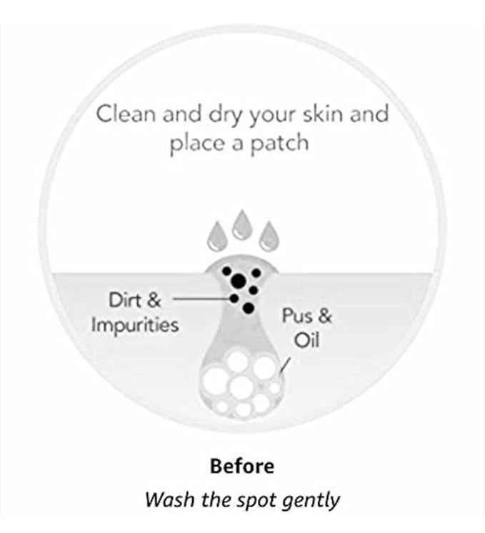 ACNE PATCHES 10 PACK 240 TOTAL HYDROCOLLOID PATCHES FD AND DERMATOLOGIST