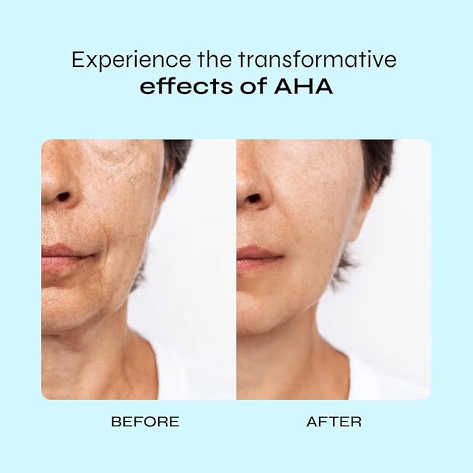 A-Cute Derm Ultra 10 AHA Anti-Aging Lotion for Exfoliation Simple and Effective for Face and Body (1 OZ)