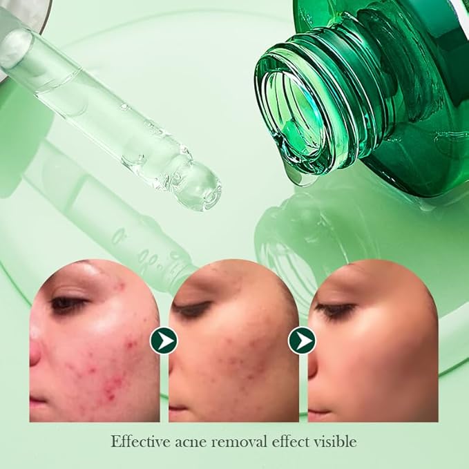 Tea Tree Oil for Face - Acne Serum - Unclog Pores, Soothe Breakouts - Blemish Spot Treatment for Smooth, Glowing Skin - Tea Tree Oil for Skin, 1.1 Fl Oz