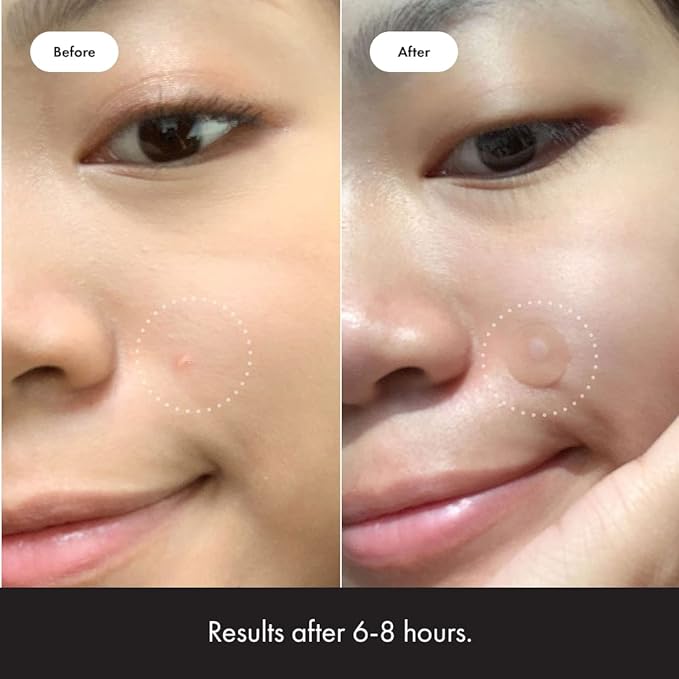 Mighty Patch™ Original patch from Hero Cosmetics - Hydrocolloid Acne Pimple Patch for Covering Zits and Blemishes in Face and Skin, Vegan-friendly and Not Tested on Animals (36 Count)