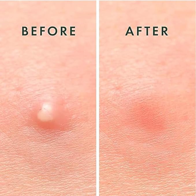 ABC Pimple Patch (72 Count)