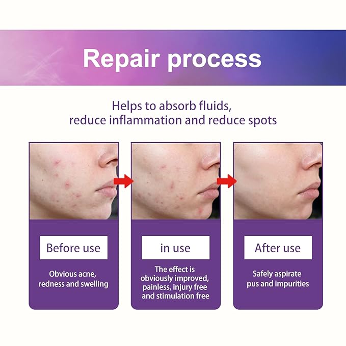 144 PCS Acne Patches Cute Pimple Patches for Face and Skin - Hydrocolloid Acne Treatment Dots to Cover and Reduce Zits, Blemishes, Spots, Star Pimple Patch