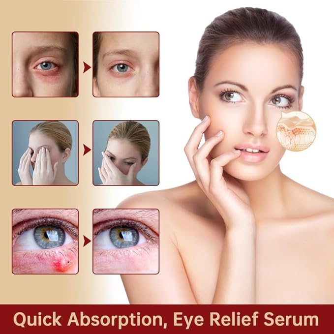 Chalazion Eye Treatment For Blepharitis, 30ml Moisturize Eyelids Serum and Chalazion Remover, Gentle Under Eye Relief Serum For Dark Circles, Eye Bags, Puffiness.