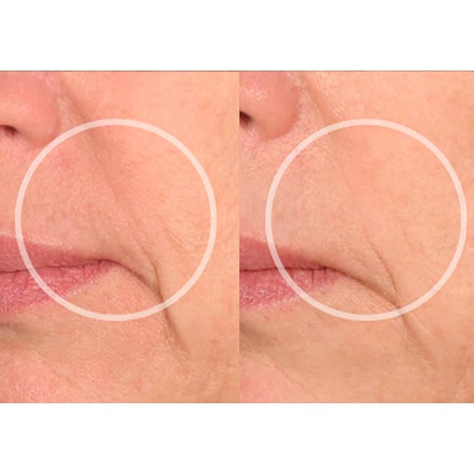 SiO Beauty Eye & Smile Lift - Eye & Smile Anti-Wrinkle Patches 2 Week Supply - Overnight Smoothing Silicone Patches for Wrinkles and Fine Lines