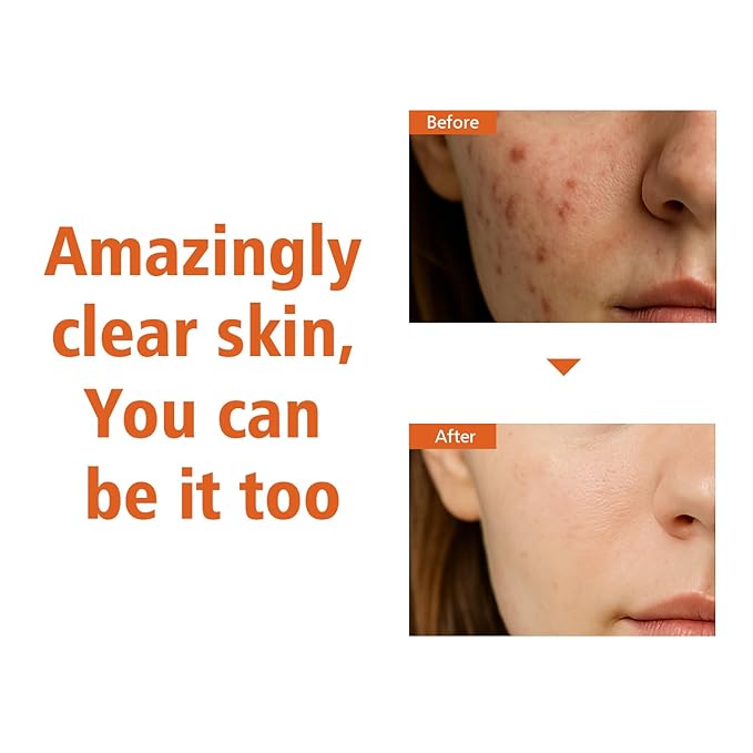 Salicylic Acid Serum for Face, Skin Clearing Serum for Oily, Blemish, Prone Skin, Hydrating Face sérum with Hyaluronic Acid, Vitamin C, Minimize Pores, Clear Acne Marks 30ml