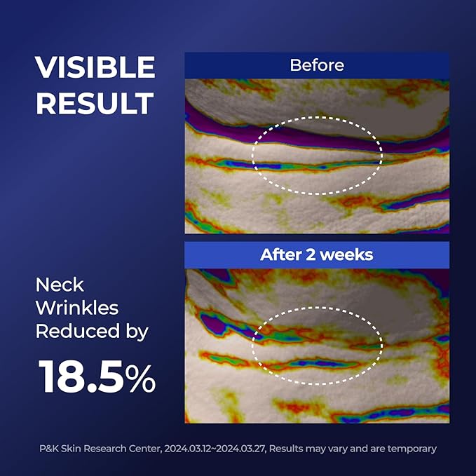 Atclinic Neck Firming Serum with Retinol & 5-Peptides – Reduce Wrinkles & Tech Neck Lines in 2 Weeks | Lightweight, Korean Skincare (1 fl oz)