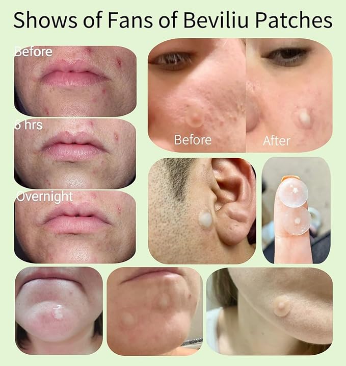 Beviliu 216 Count Pimple Patches for Face(Tea Tree Oil & Ultra-Thin Day/Thick Night Use) Hydrocolloid Acne Patches for Face, Zit Patches for Face, 2 Sizes, Facial Skin Care Products