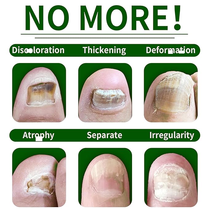 2Pcs Ginger Nail Strengthener for Damaged Nails, Hand and Foot Nail Growth Serum Kit, Ginger Nail Serum for Cracked Nails, Hand & Foot Strengthener Set, Fingernail Repair for Split, 30ML Each