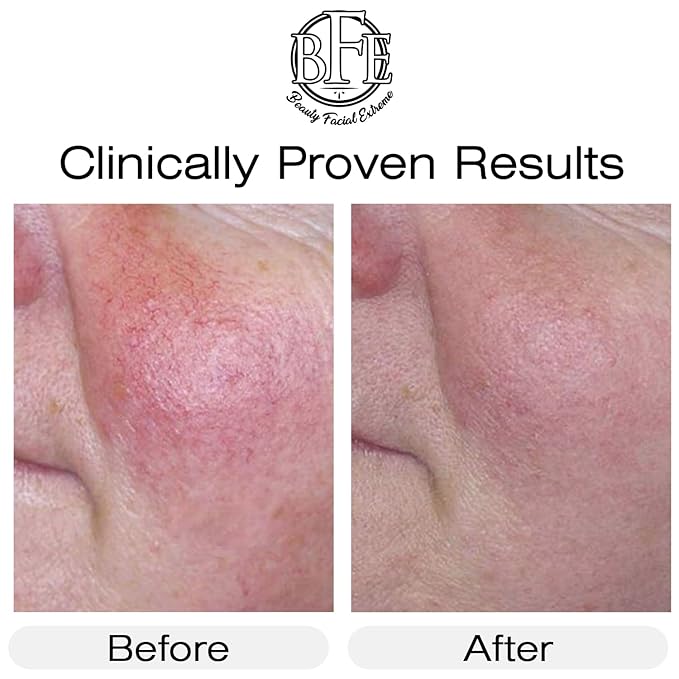 Vitamin K Cream- Moisturizing Bruise Healing Formula. Dark Spot Corrector for Bruising, Spider Veins & Broken Capillaries. Reduces Under Eye Dark Circles, Fine Lines, Puffiness, & Wrinkles.