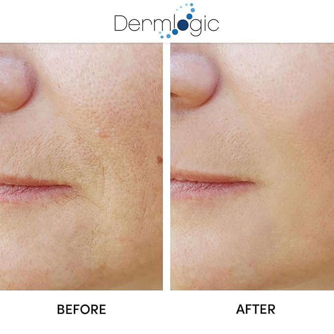 Anti Aging Resurfacing Peel Pads - Contains Salicylic, Glycolic, & Lactic for Face & Body. Includes Hyaluronic, & Witch Hazel, Green Tea & Aloe Vera. Exfoliates to Correct Dark Spots & Scars. 