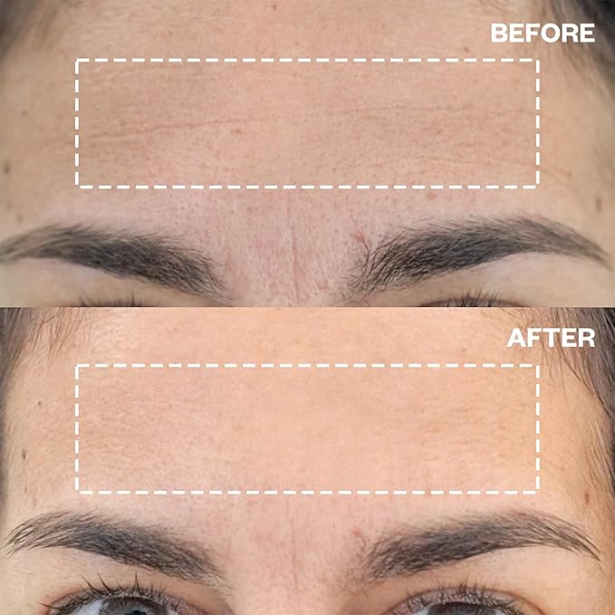 Wrinkles Schminkles Silicone Anti-Wrinkle Patch Bundle – Forehead Wrinkle Patches & Under Eye Patches – Reusable, Non-Invasive Pads for Fine Lines, Puffiness & Dark Circles