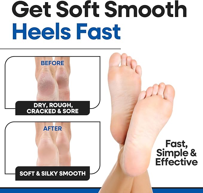Moisturizing Socks | Cracked Heel Treatment with Aloe Vera | Moisturizer Foot Callus Remover | Aloe Socks for Cracked Heels & Dry Cracked Feet | Lotion Infused Gel Heel Socks (Fits Most)