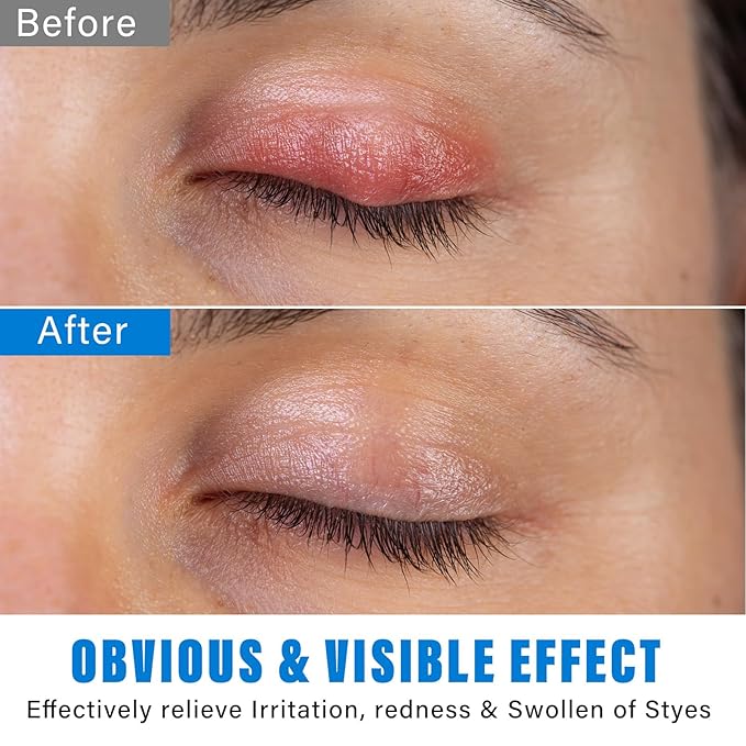 Stye Eye Treatment, Natural Stye Eye Relief Serum, for Styes Chalazion and Blepharitis Treatment, Restored Healthier Eye Skin, Blue