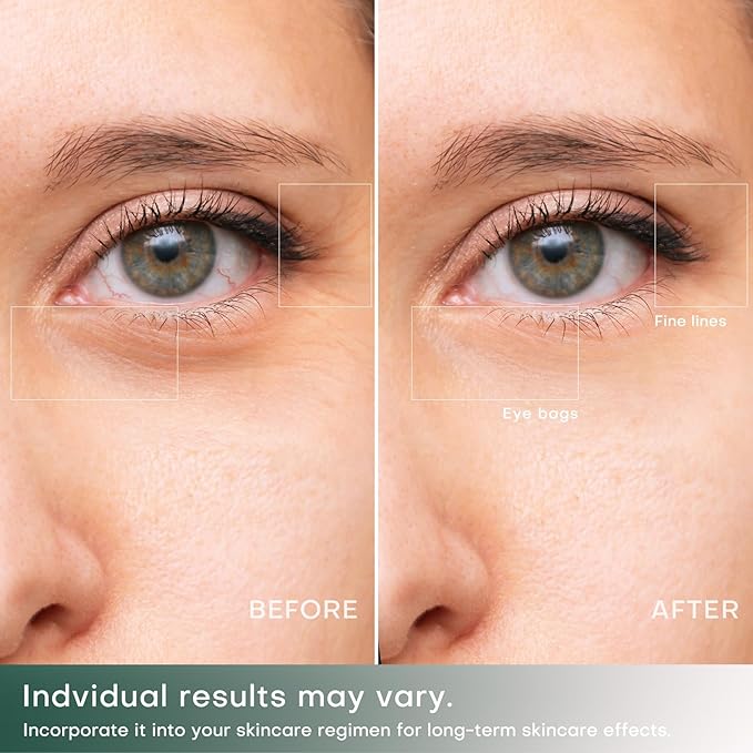 Puffiness Under Eye Bags Wrinkles Fine Line Reduce Device With Gold Plated Treatment Head Current Radio Frequency Wireless Professional RF Skin Care Beauty Device (With Gel)