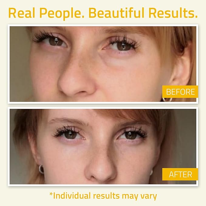 YEOUTH Under Eye Gel with Hyaluronic Acid for Puffiness, Under Eye Bags & Circles, Hydrating Skincare for Tired-Looking Eyes 1oz