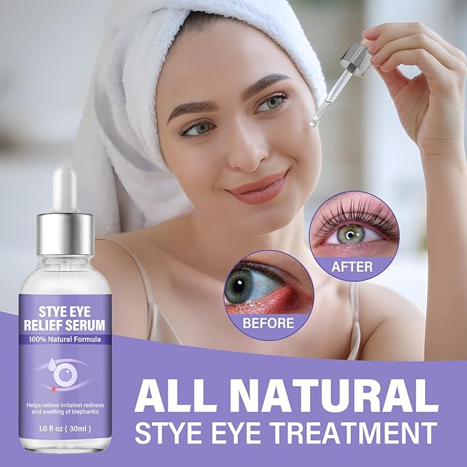 Stye Eye Treatment, Natural Stye Relief Serum, Gently Cleanses Lashes and Eyes, Chalazion and Blepharitis Treatment，Relieves Eye Irritation