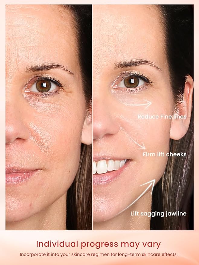 Radio Frequency Skin Tightening Device, Anti-Aging Face Machine for Wrinkle Removal, Lifting & Firming, Wireless Home Beauty Device with 3 Levels, at-Home Skin Renewal