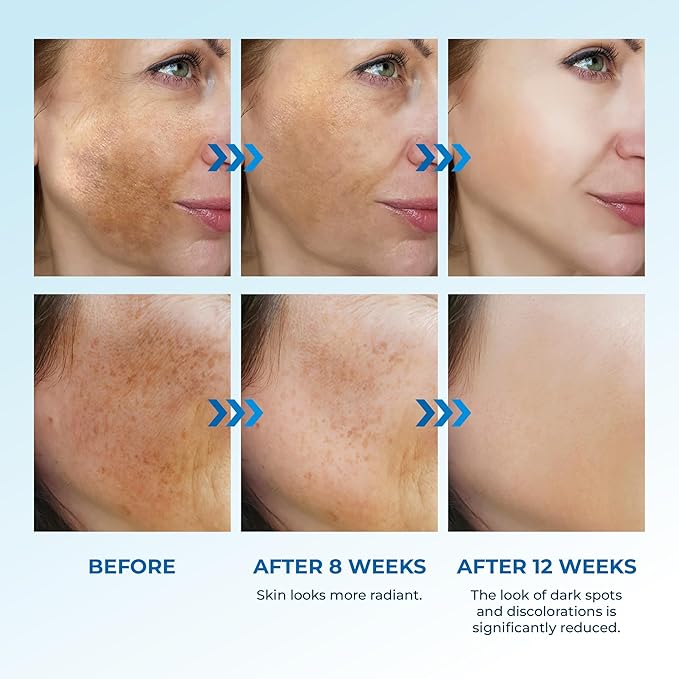 Abera Dark Spot Serum for Face, Dark Spot Corrector, Melasma & Age Spot Treatment, Boost Moisturization & Pore Minimize, All Skin Types, 0.68 fl Oz, Set of 3