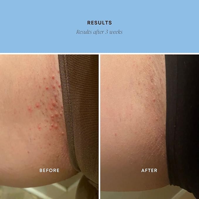 Bushbalm Ingrown Hair Exfoliating Scrub - Reduces Appearance of Ingrown Hairs and Underarm Bumps, Soothes Skin and Post Shave Redness - Nude, 236 ml