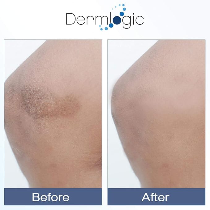 Vitamin K Cream- Moisturizing Bruise Healing Formula. Dark Spot Corrector for Bruising, Spider Veins & Broken Capillaries. Reduces Under Eye Dark Circles, Fine Lines, Puffiness, & Wrinkles with Arnica