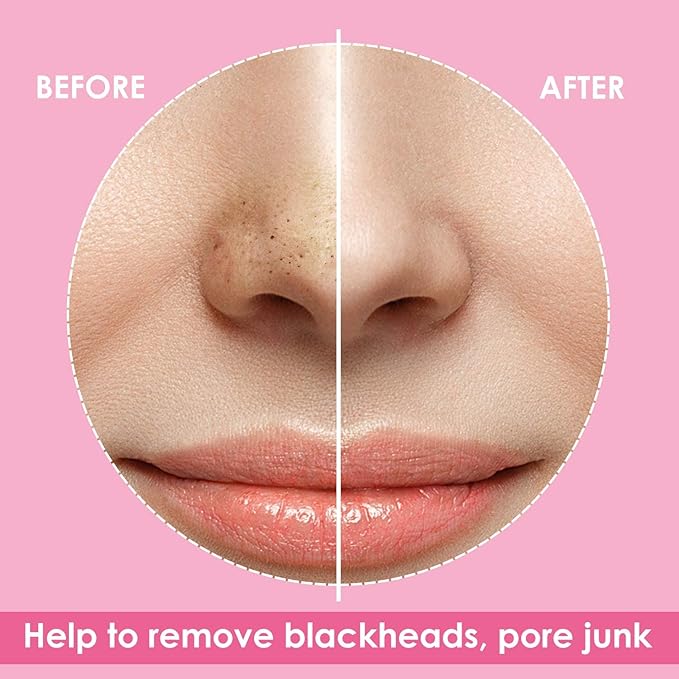 Blackhead Remover Pore Strips for Nose - 65 Strips - Charcoal Blackheads Removal - Blackhead Strip - Pore Cleaner