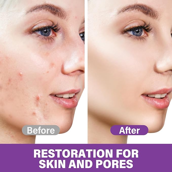 Azelaic Acid Serum, Azelaic Acid 12% Facial Cream, Hyaluronic Acid & Niacinamide for Redness Relief Face, Balance Excess Sebum, 20g