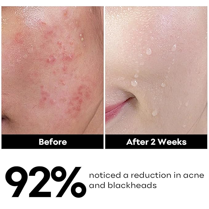 Deep Pore Clearing Mask with Salicylic Acid Face Cleanser Set, Removes Excess Oil, Reducer for Blackhead, Whitehead, Acne and Pores for Oily & Sensitive Skin Care for Women Men