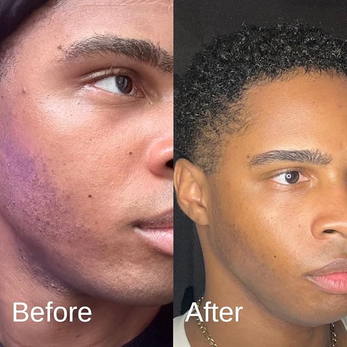 Acne System for Men and Boys, Face Wash, Moisturizer, Pimple Patches, Shield Men's Skin Care Set (2 Months)