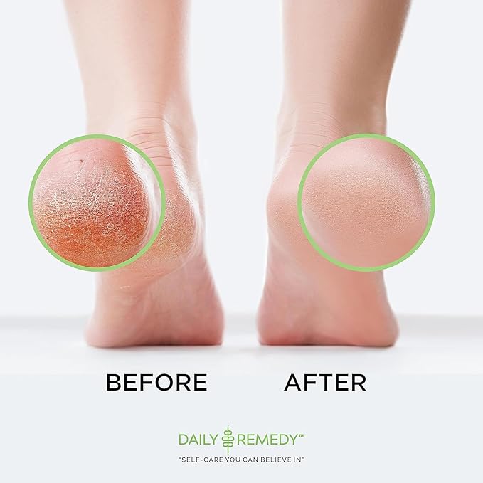 Callus Remover Gel – Professional Foot Callus Removal for Smooth Feet & Cracked Heels – Extra Strength Callus Gel with Pumice Stone – 8oz, Made in USA