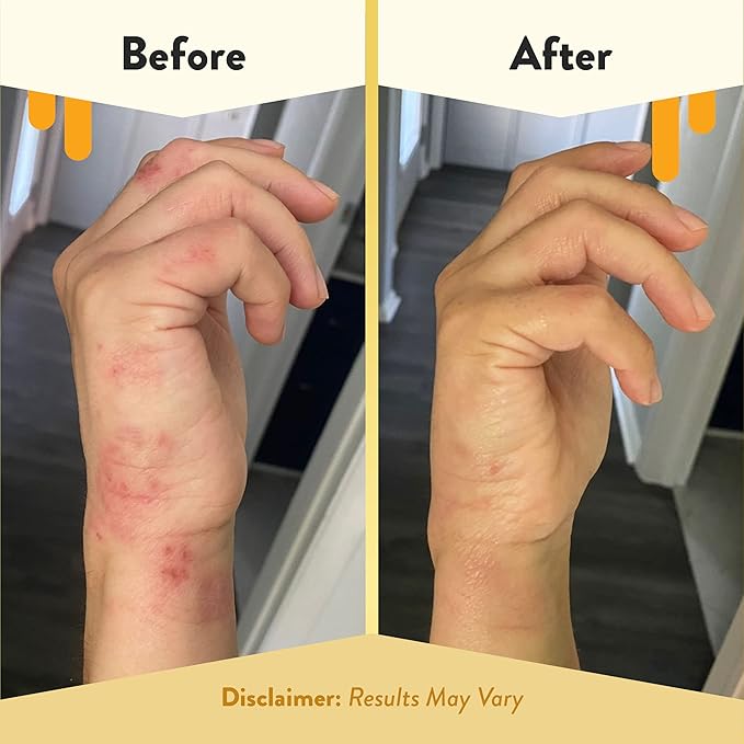 ECZEMA HONEY Antioxidant Body Oil - After Shower All Over Body Oil Spray for Skin - Eczema-Prone & Sensitive Moisturizing Skin Oil - Unscented Body Oils for Women, Men & Kids (8 Fl Oz)