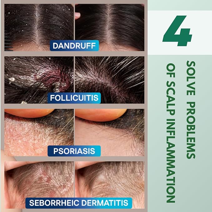 ABERA Alan Silver Serum - Clinically Proven to Soothe Irritated Skin and Improve The Appearance of Skin with Mild to Moderate Psoriasis (2 Boxes)