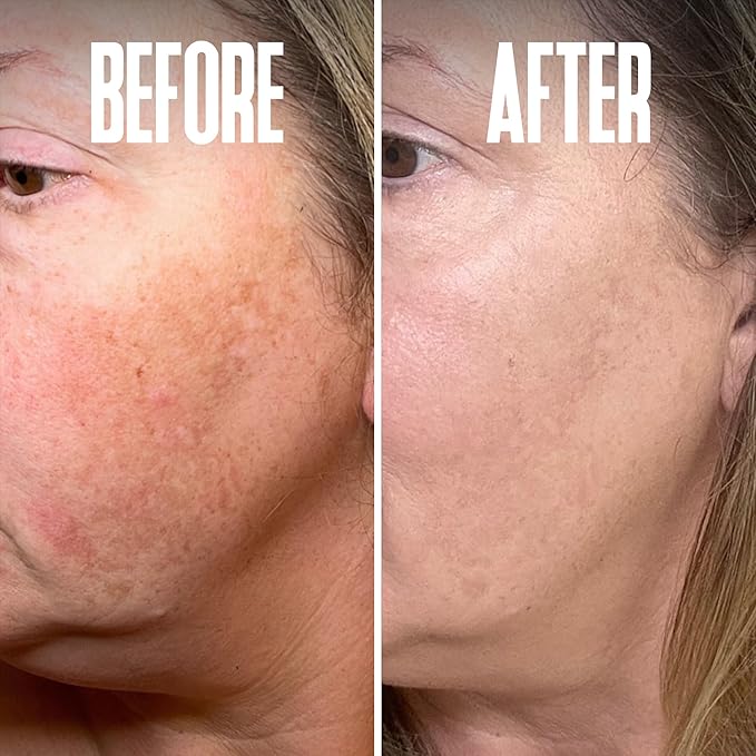 Save 18% on The Skin Care Solution For Dark Spots, Razor Bumps, Ingrown Hair & Razor Burns – Includes Our Ultra Potent Brightening + Razor Bumps Pads For an Ultra Clear & Glowing Skin