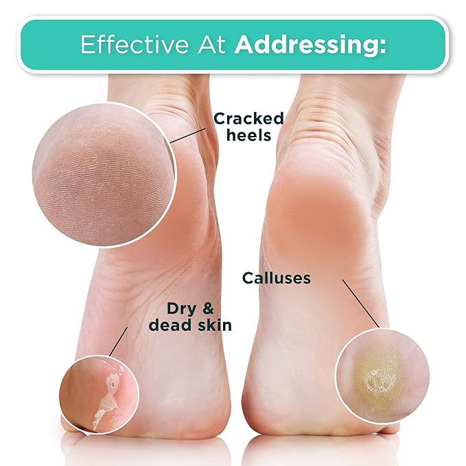 DERMORA Foot Peel Mask - 2 Pack of Regular Size Skin Exfoliating Foot Masks for Dry, Cracked Feet, Callus, Dead Skin Remover for Baby Soft Feet, Coconut Scent