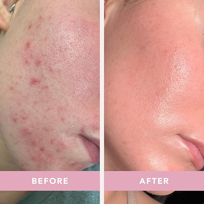 Doll 10 - Smooth Assist Overnight Facial 11% Triple-Acid Resurfacing Serum - Proven Overnight Transformation - Improves Skin Tone, Pores, Wrinkles & More - Vegan, Cruelty Free & No Parabens (1 oz)